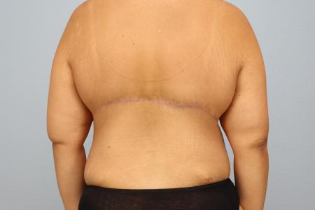 After image 3 Case #126181 - Tummy Tuck and Bra Line Back Lift Results by Dr. N