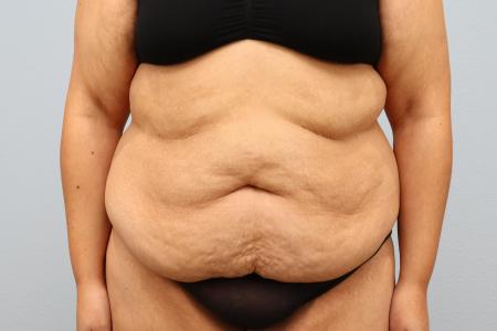 Before image 1 Case #126181 - Tummy Tuck and Bra Line Back Lift Results by Dr. N