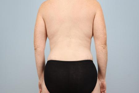 After image 3 Case #126171 - Mommy Makeover by Dr. Neaman | Salem, OR