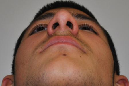 Before image 6 Case #126761 - Primary Rhinoplasty