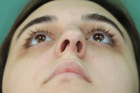 Before image 6 Case #122886 - Functional Aesthetic Septorhinoplasty