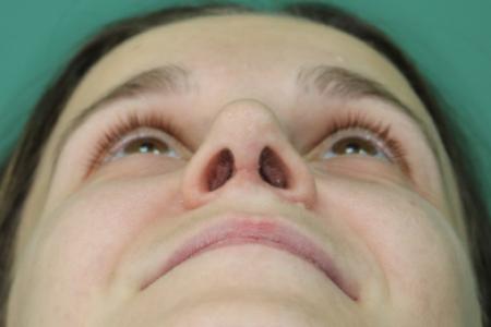 After image 6 Case #122911 - Primary Septorhinoplasty