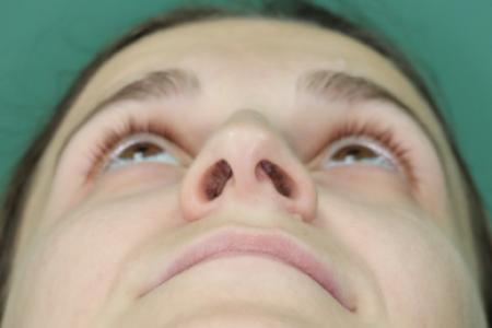 Before image 6 Case #122911 - Primary Septorhinoplasty