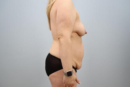 Before image 3 Case #126186 - Skin Removal Surgery Mommy Makeover
