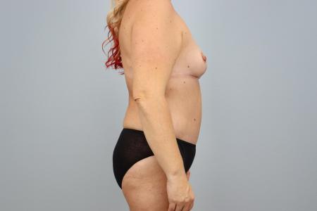 After image 3 Case #126186 - Skin Removal Surgery Mommy Makeover