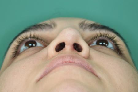 After image 6 Case #126796 - Nasal Deviation Syndrome. Rhinogenic Headache 