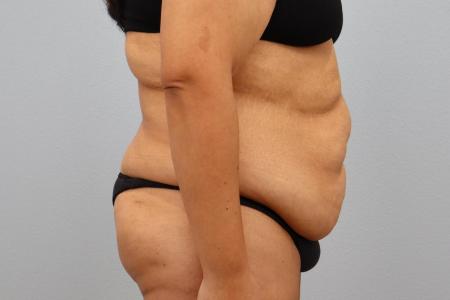 Before image 2 Case #126181 - Tummy Tuck and Bra Line Back Lift Results by Dr. N