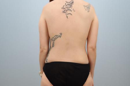 Before image 3 Case #126196 - Tummy Tuck with Breast Enhancement | Salem Oregon