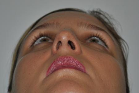 Before image 6 Case #126766 - Nasal Deviation Syndrome