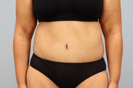 After image 1 Case #126181 - Tummy Tuck and Bra Line Back Lift Results by Dr. N