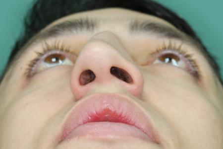 Before image 6 Case #126756 - Nasal Deviation Syndrome