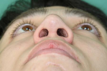 After image 6 Case #126756 - Nasal Deviation Syndrome