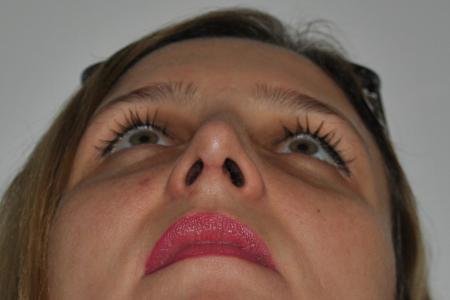 After image 6 Case #126766 - Nasal Deviation Syndrome