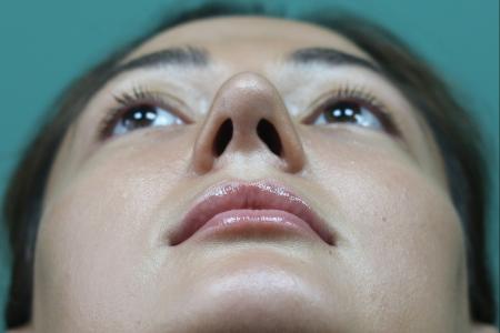 After image 6 Case #126811 - Reduction Rhinoplasty