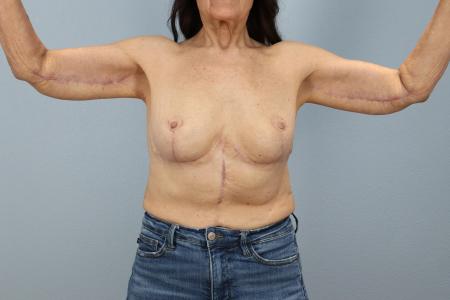 After image 1 Case #126721 - Arm Lift Surgery | Results by Dr. Neaman