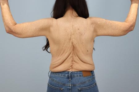 After image 2 Case #126721 - Arm Lift Surgery | Results by Dr. Neaman