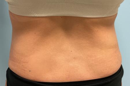 Before image 3 Case #127266 - 43 y.o. female w/ abdominoplasty & lipo of flanks
