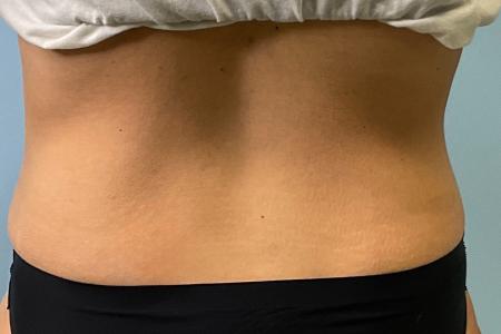 After image 3 Case #127266 - 43 y.o. female w/ abdominoplasty & lipo of flanks