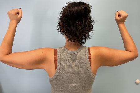 After image 1 Case #127231 - 39 y.o. Female w/ Bilateral Brachioplasty and Lipo