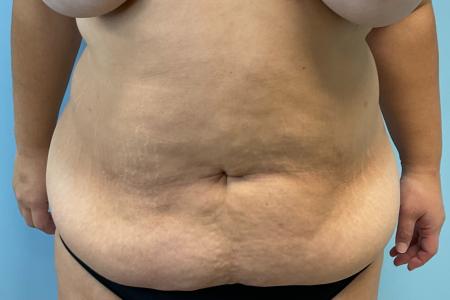 Before image 1 Case #127386 - 35 y.o. female w/ Tummy Tuck & Lipo of flanks 