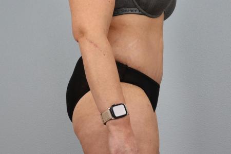 After image 2 Case #128291 - Tummy Tuck 6 months post-op | Salem, OR