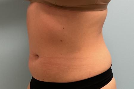 Before image 2 Case #127931 - 30 y.o. female w/ Lipo of abs, flanks w/ Renuvion