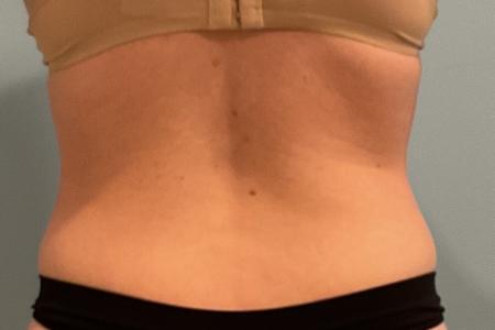 After image 3 Case #127931 - 30 y.o. female w/ Lipo of abs, flanks w/ Renuvion