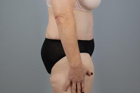 After image 2 Case #127941 - Tummy Tuck Before and After – 60-Year-Old Female