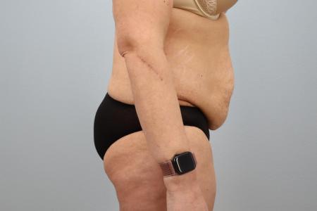 Before image 2 Case #128291 - Tummy Tuck 6 months post-op | Salem, OR