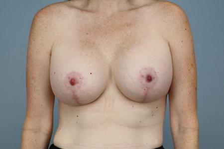 After image 1 Case #127956 - Breast Lift with Implants 7-Month Results