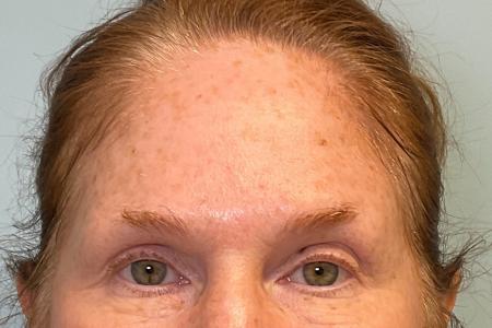Before image 3 Case #127936 - 56 y.o. female with Botox 