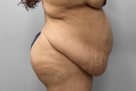 Before image 3 Case #127691 - Mommy Makeover