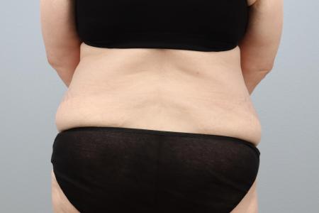 Before image 3 Case #127941 - Tummy Tuck Before and After – 60-Year-Old Female