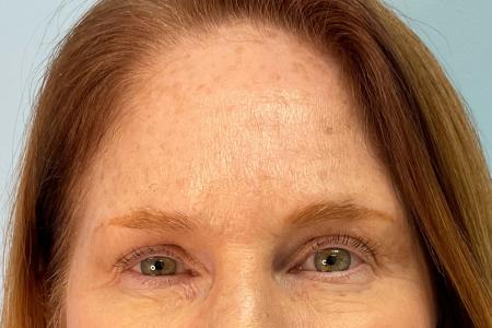 After image 3 Case #127936 - 56 y.o. female with Botox 