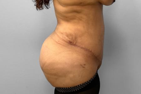 After image 3 Case #127691 - Mommy Makeover