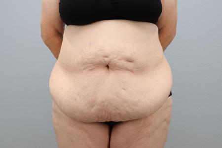 Before image 1 Case #127941 - Tummy Tuck Before and After – 60-Year-Old Female