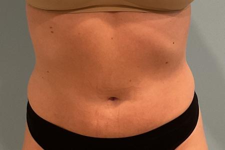 After image 1 Case #127931 - 30 y.o. female w/ Lipo of abs, flanks w/ Renuvion