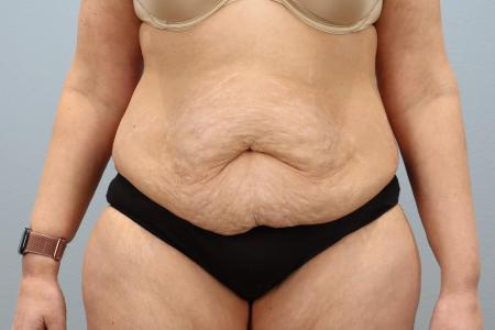 Before image 1 Case #128291 - Tummy Tuck 6 months post-op | Salem, OR