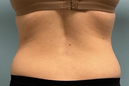 Before image 3 Case #127931 - 30 y.o. female w/ Lipo of abs, flanks w/ Renuvion