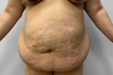 Before image 1 Case #127691 - Mommy Makeover