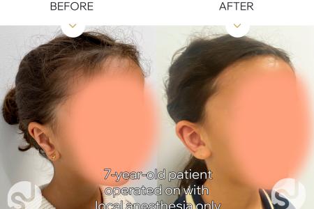 After image 1 Case #128166 - Secondary Otoplasty