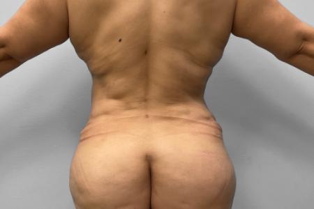 After image 4 Case #127691 - Mommy Makeover