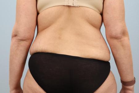 Before image 3 Case #128291 - Tummy Tuck 6 months post-op | Salem, OR