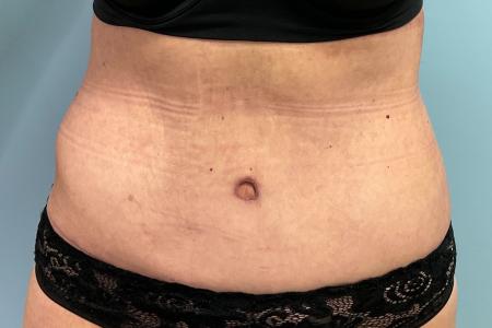 After image 1 Case #127556 - Tummy Tuck + Lipo of Flanks/Thighs + Bra Line Lift