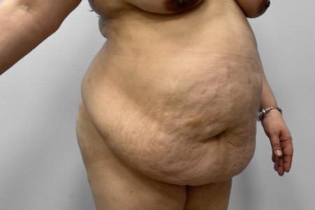 Before image 2 Case #127691 - Mommy Makeover