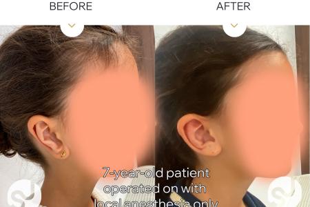 Before image 1 Case #128166 - Secondary Otoplasty