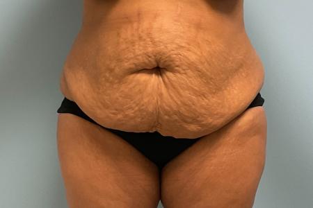 Before image 1 Case #128716 - 50 y.o female with Tummy Tuck, BBL, & Lipo