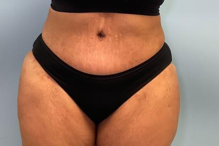After image 1 Case #128716 - 50 y.o female with Tummy Tuck, BBL, & Lipo