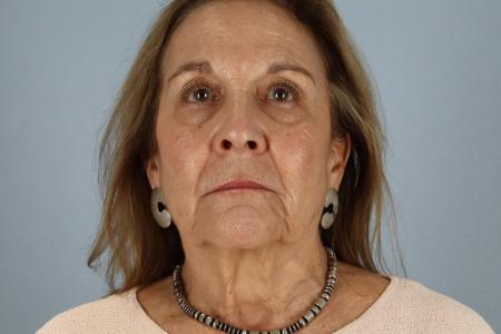 Before image 1 Case #128541 - Facelift and Eyelid Surgery Before and After 