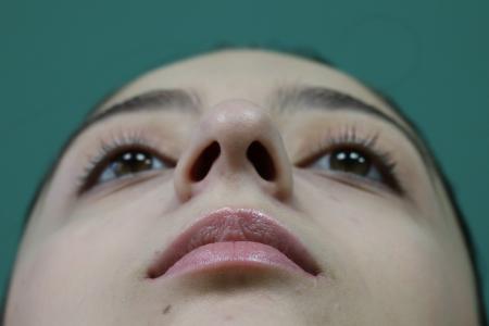 Before image 6 Case #128876 - Primary Rhinoseptoplasty